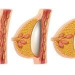 Augmentation mammaire